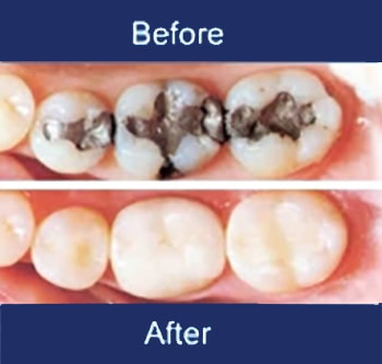 Fillings Before and After in Saint-Augustin, Mirabel