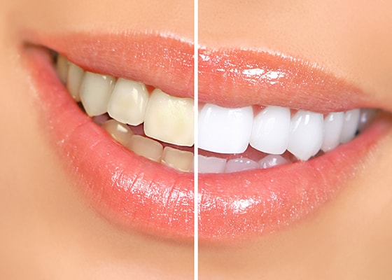 teeth whitening - Saint-Augustin, Mirabel