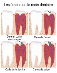 Preventative Dentistry in Saint-Dorothee, Laval