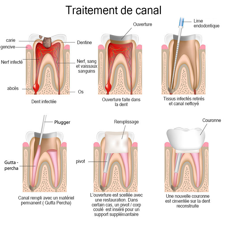 Root Canals in Saint-Dorothee, Laval
